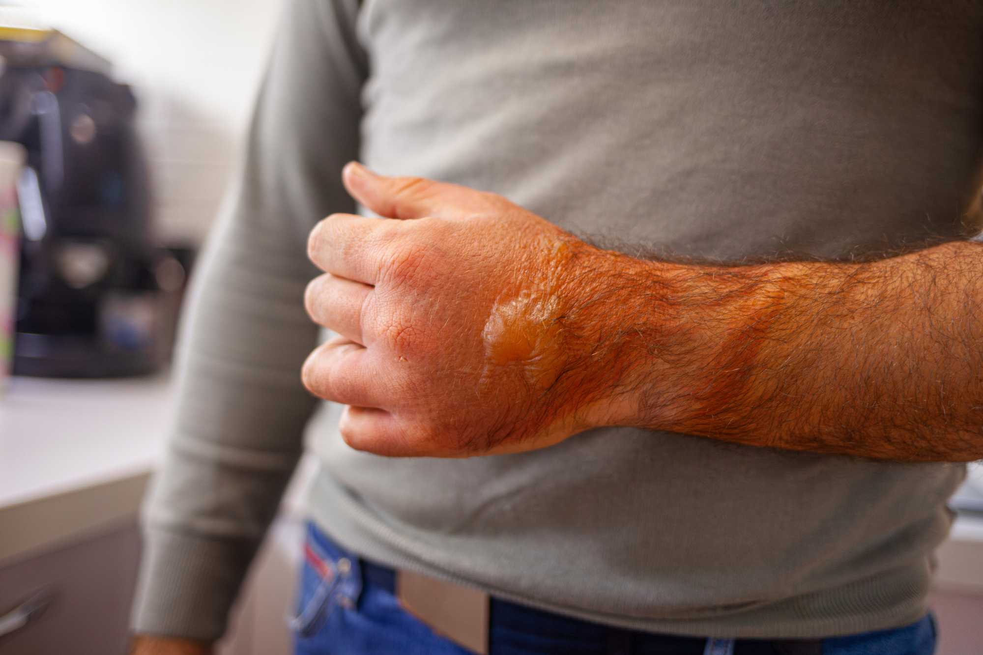 Vyhojená popálenina jazvou